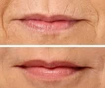 botox en codigo de barras clinica franco