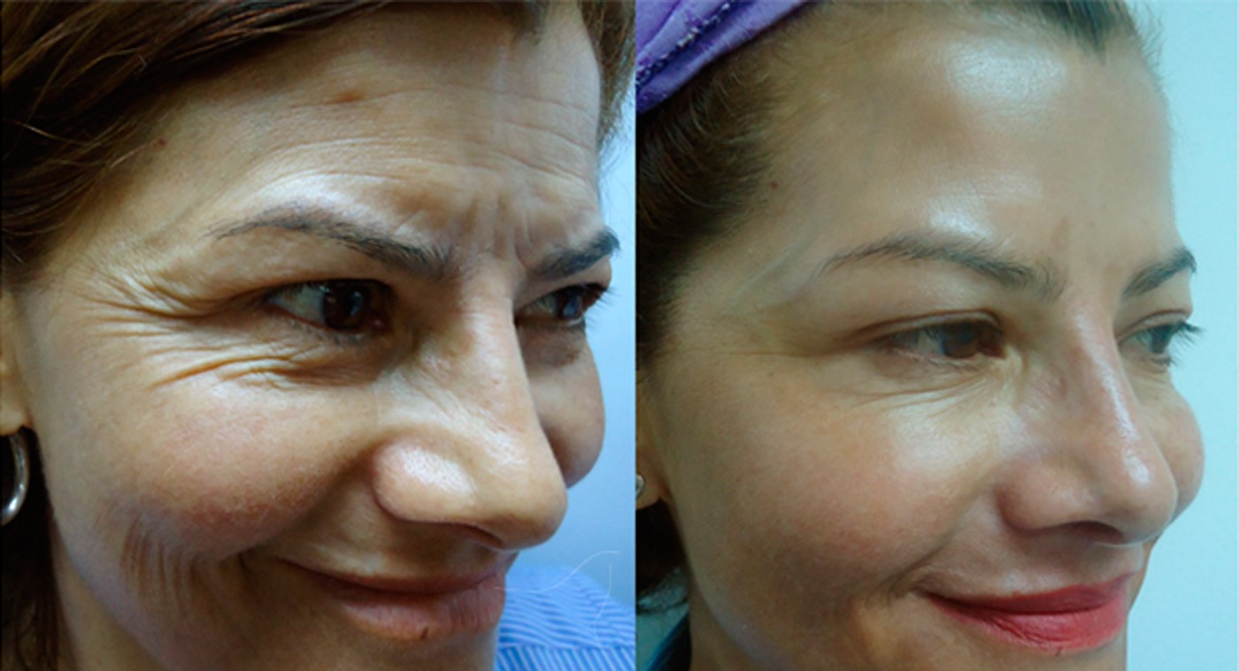 botox en Todo el rostro clinica franco Toluca