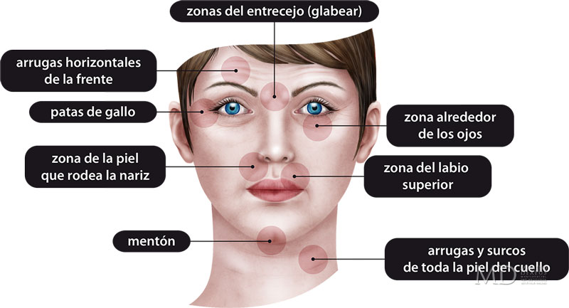 zonas de aplicacion de botox toluca