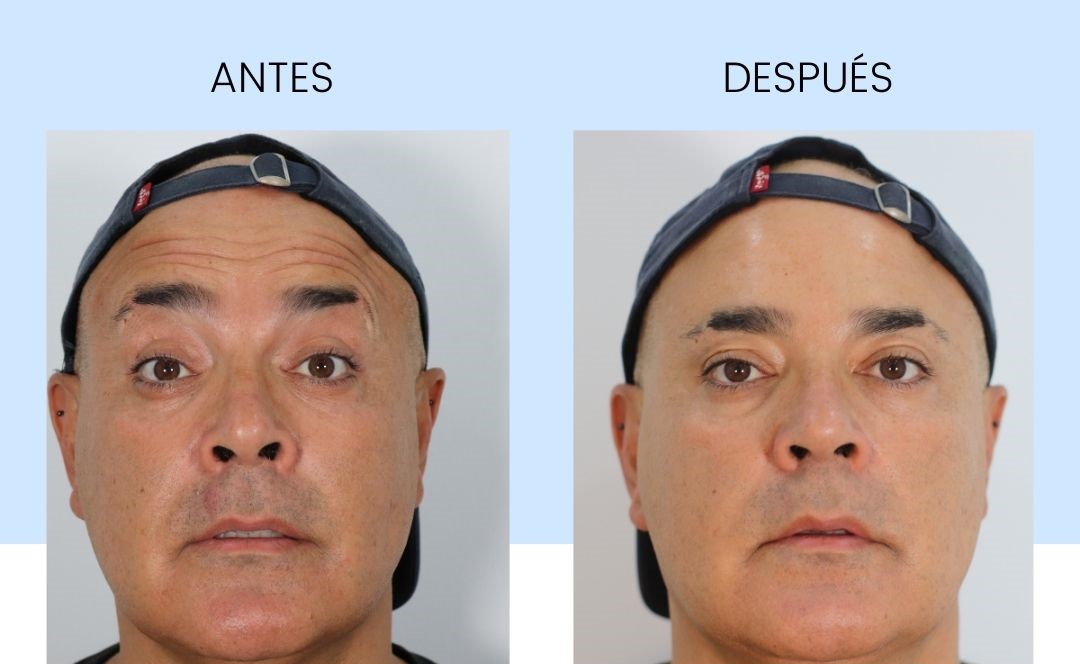 antes y despues toxina botulinica toluca