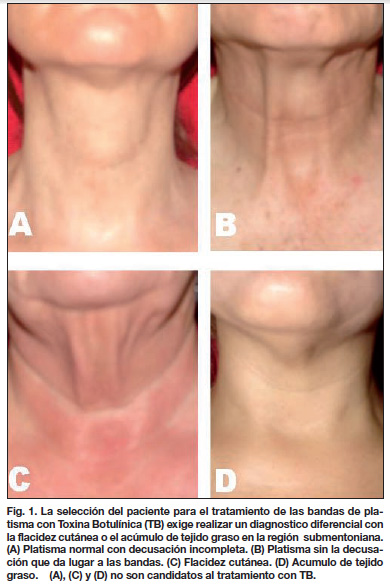 toxina botulinica rejuvenecimiento del cuello