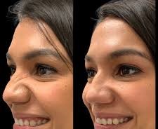 botox en la nariz clinica franco Toluca